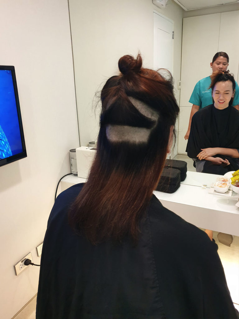 MEGA | This Procedure Will Help You Achieve A More Feminine Hairline