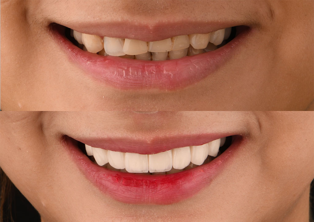 zirconia veneers, before and after