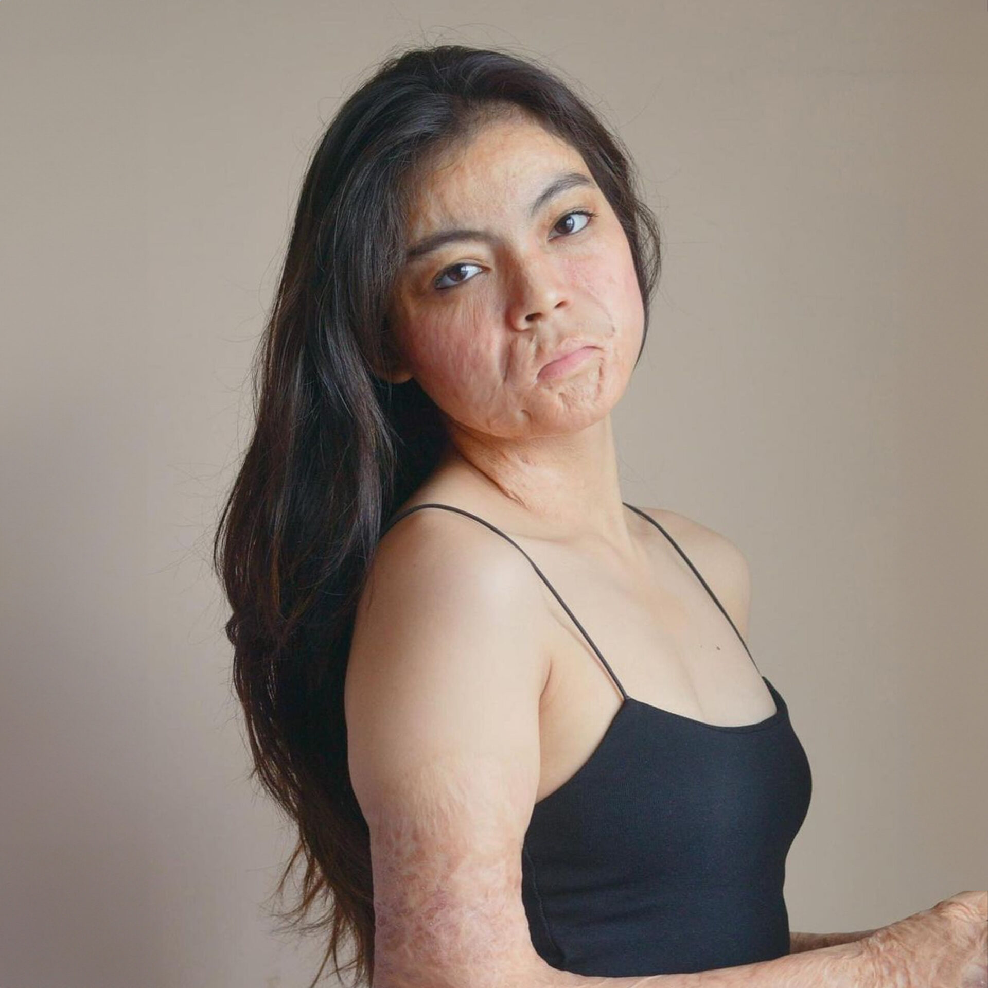 Larra Lasam Burn Survivor Beauty