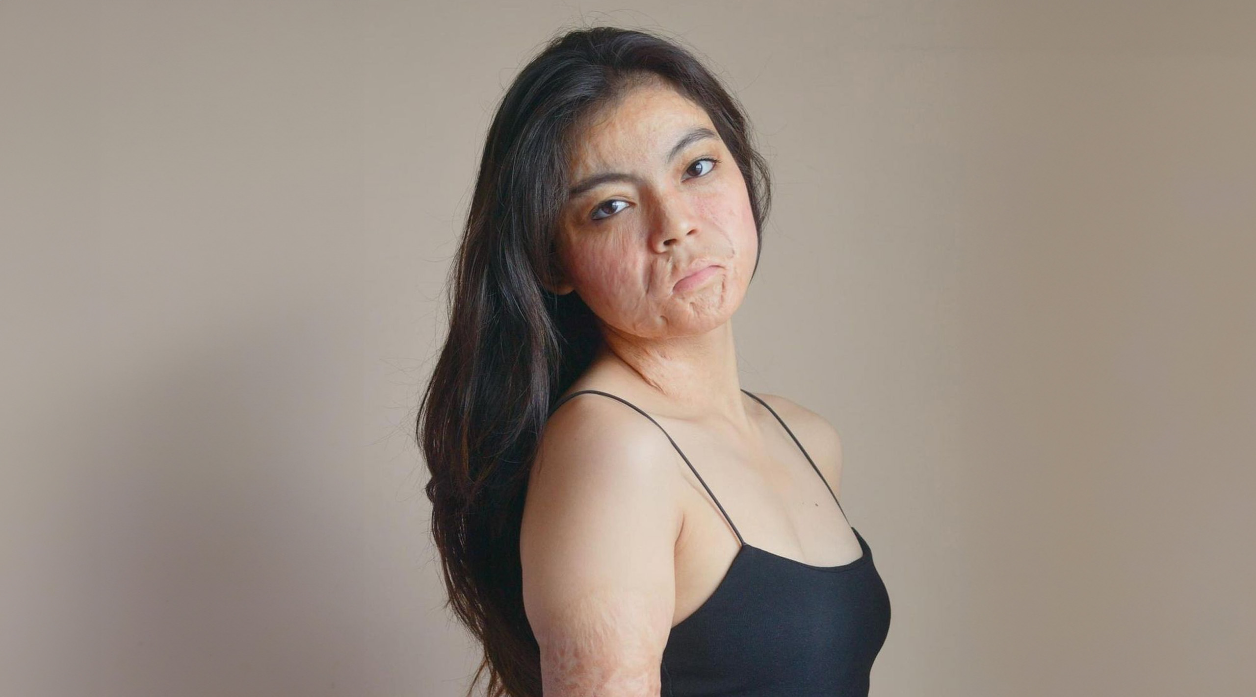 Larra Lasam Burn Survivor Beauty