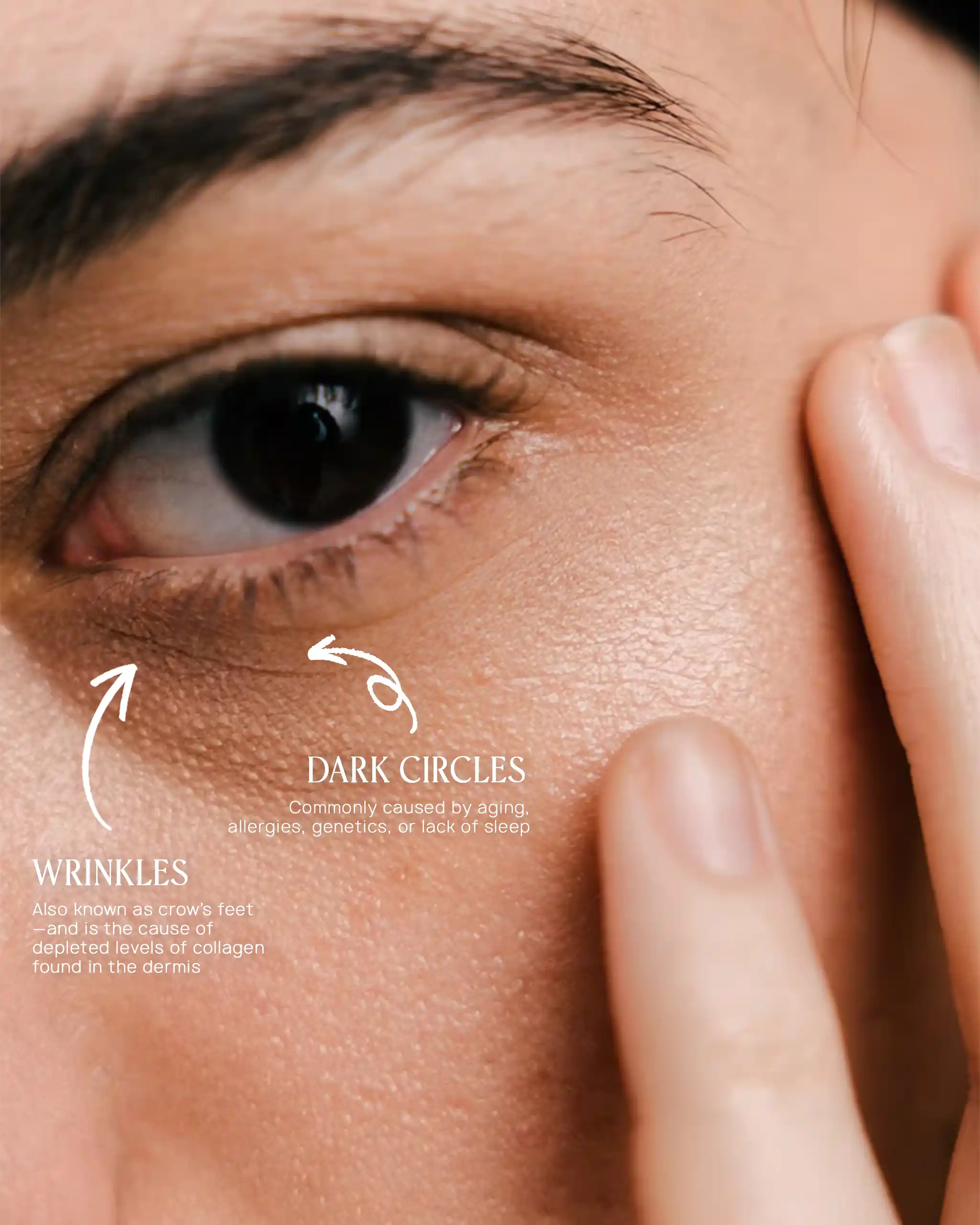 Wrinkles and Dark Circles