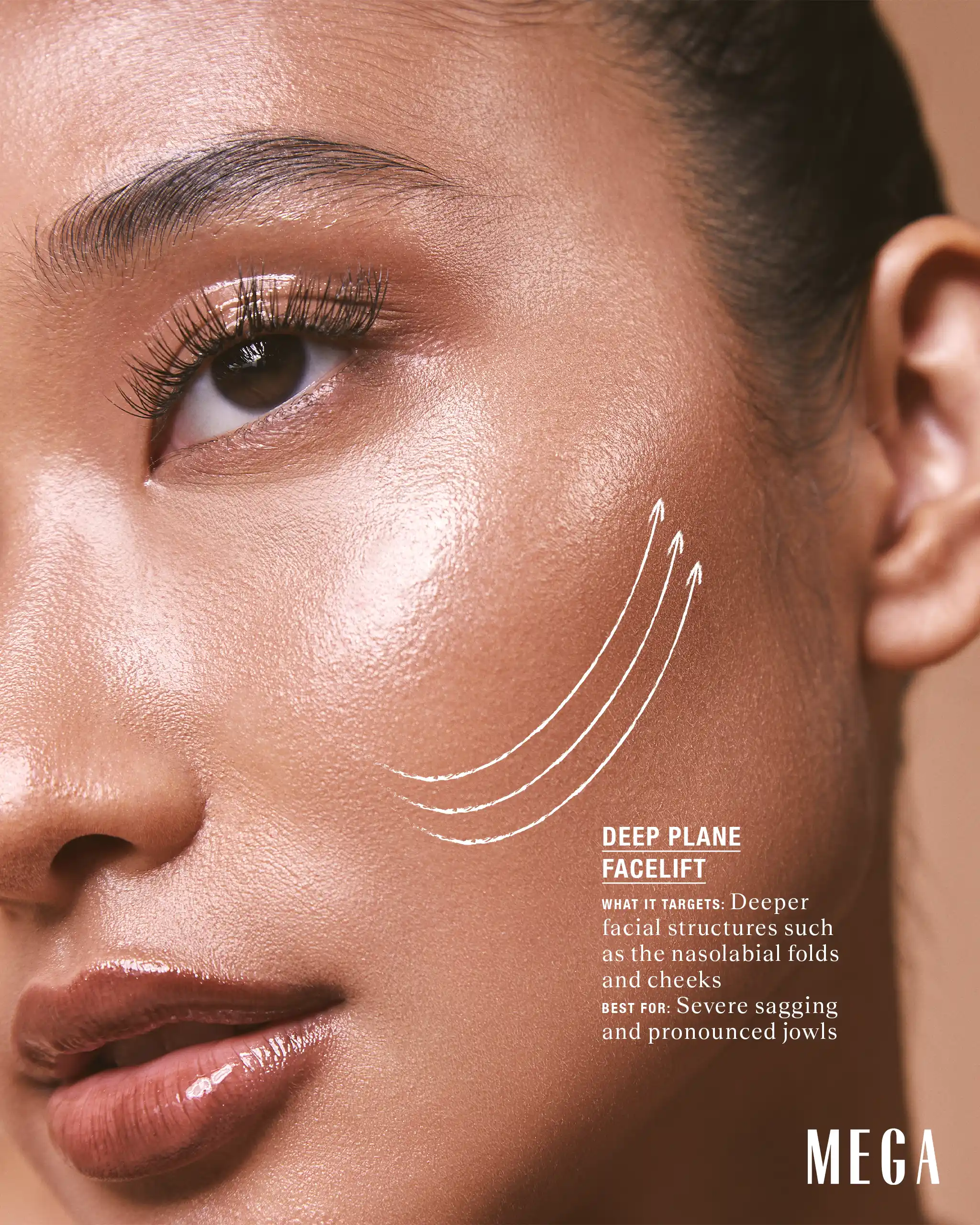 Deep Plane Facelift