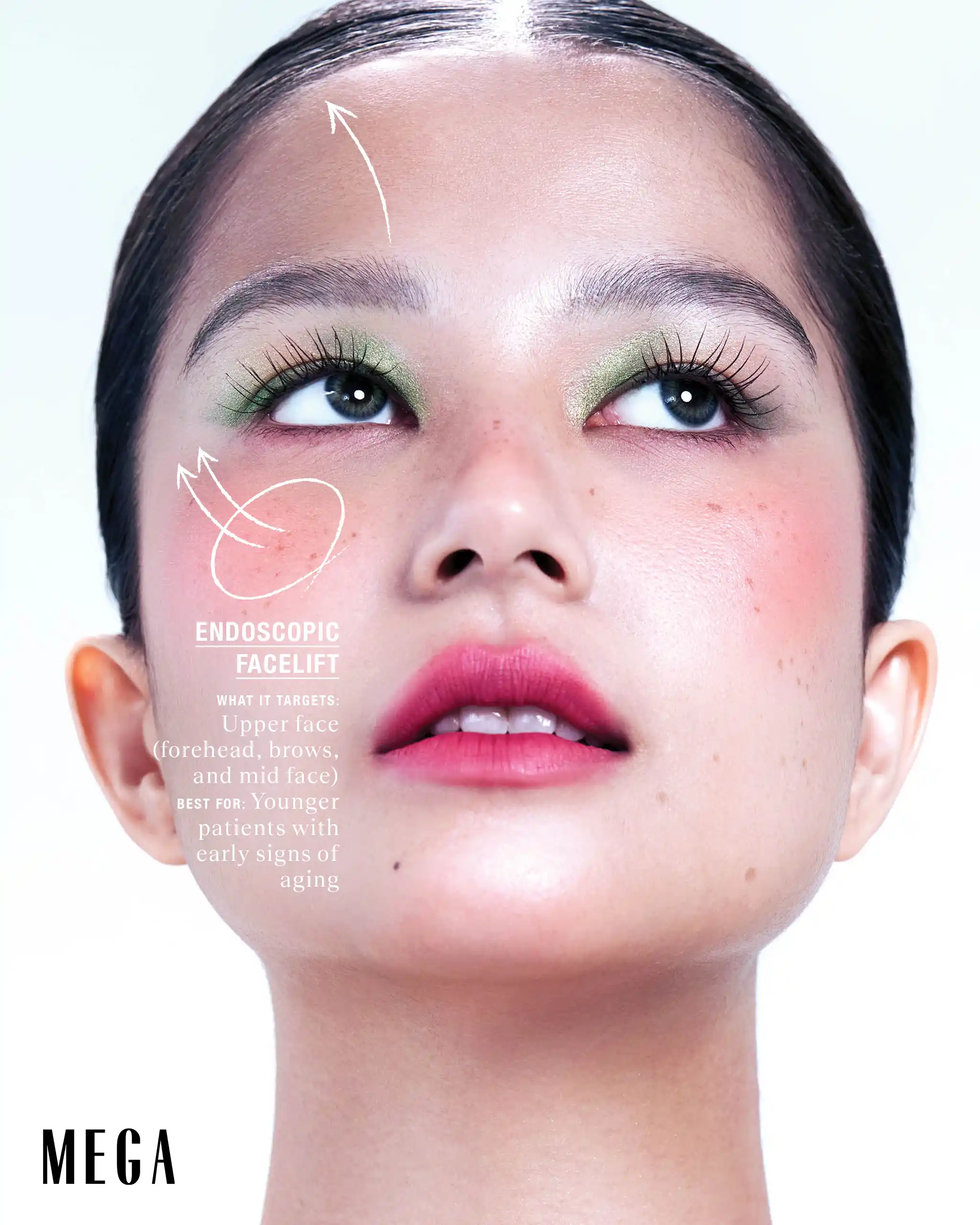 Endoscopic Facelift