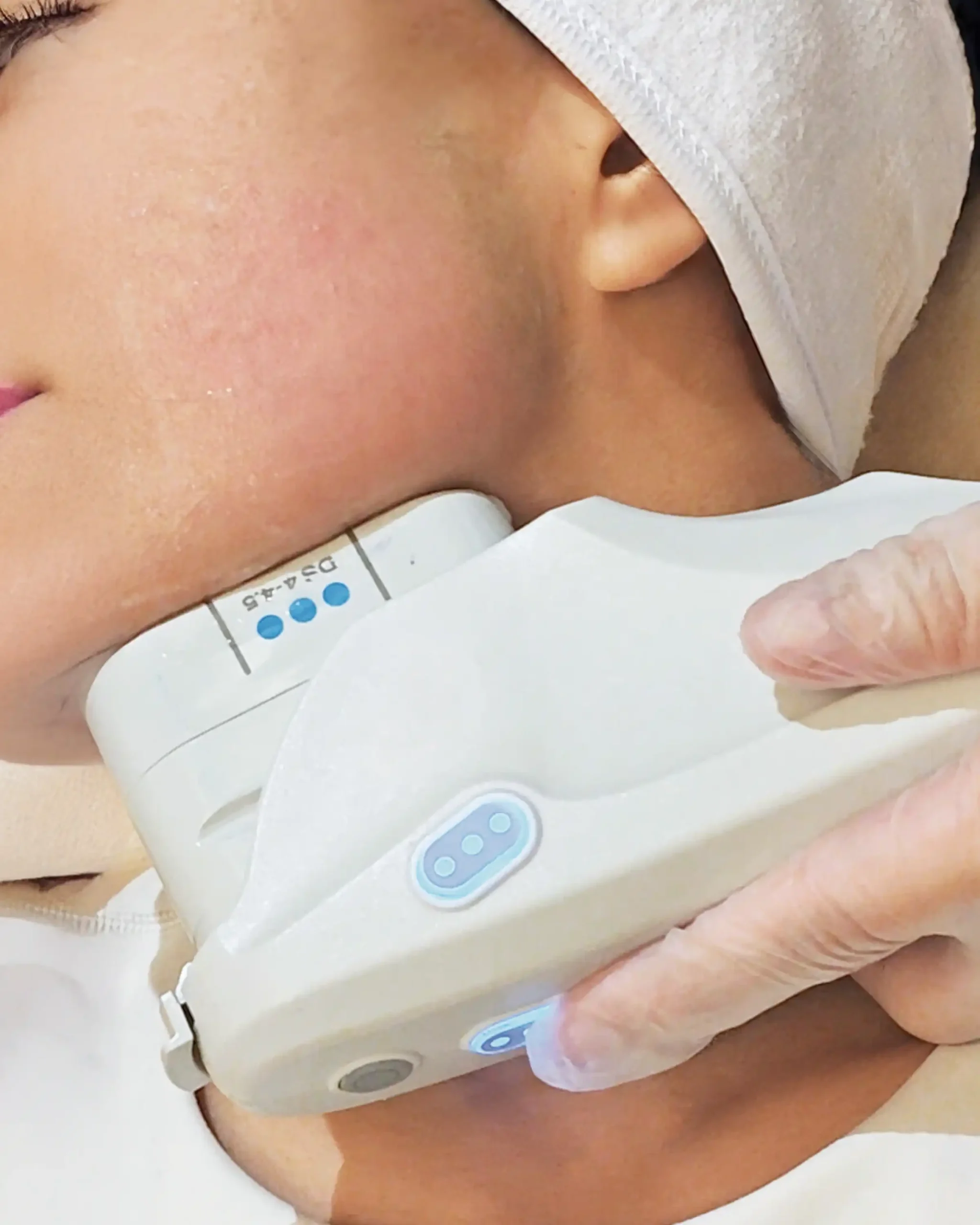 ULTHERAPY Prime Treatment